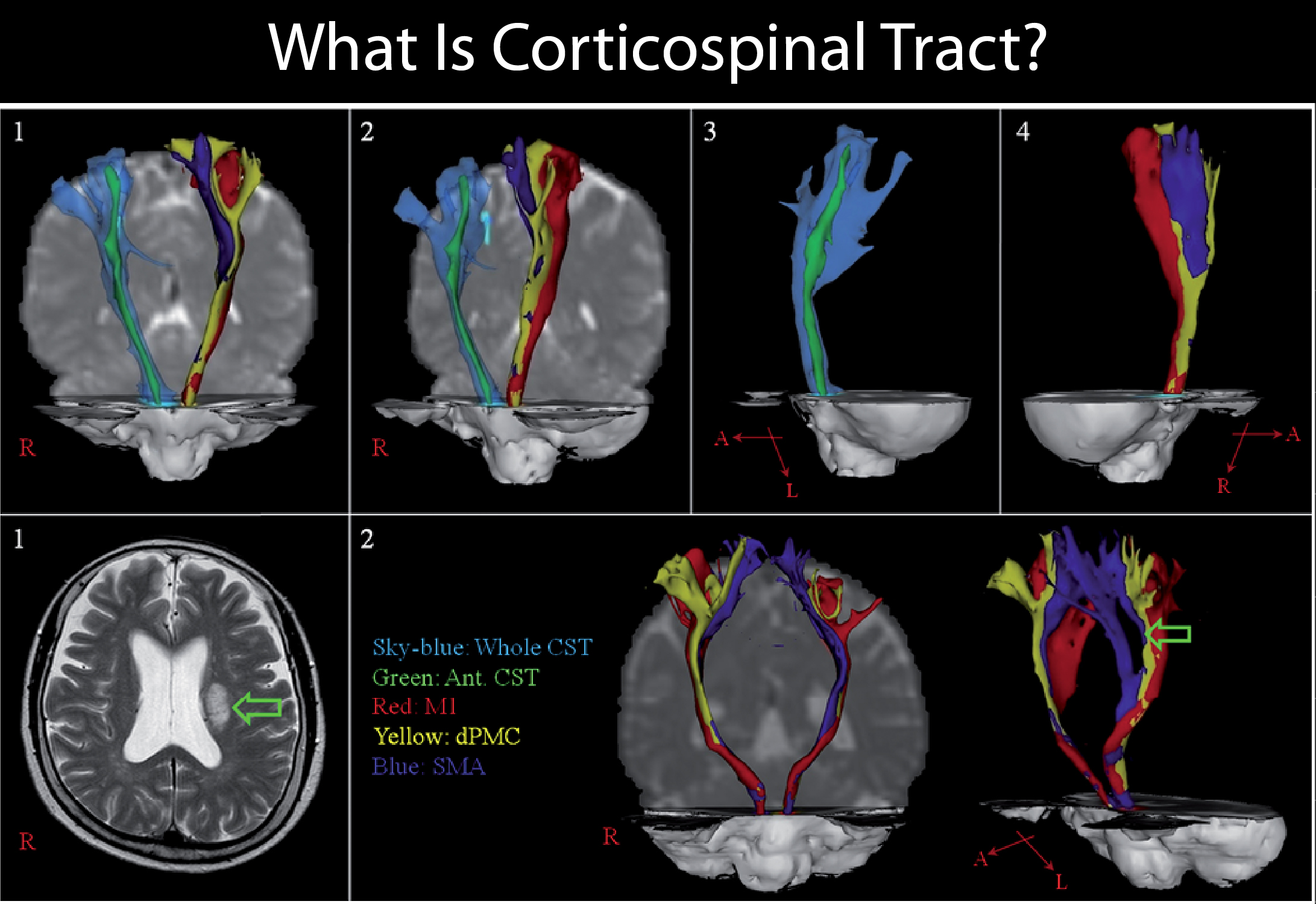 What Is Corticospinal Tract?