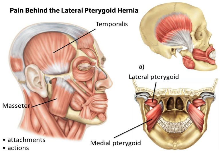 An Introduction to Pain Behind the Lateral Pterygoid Hernia