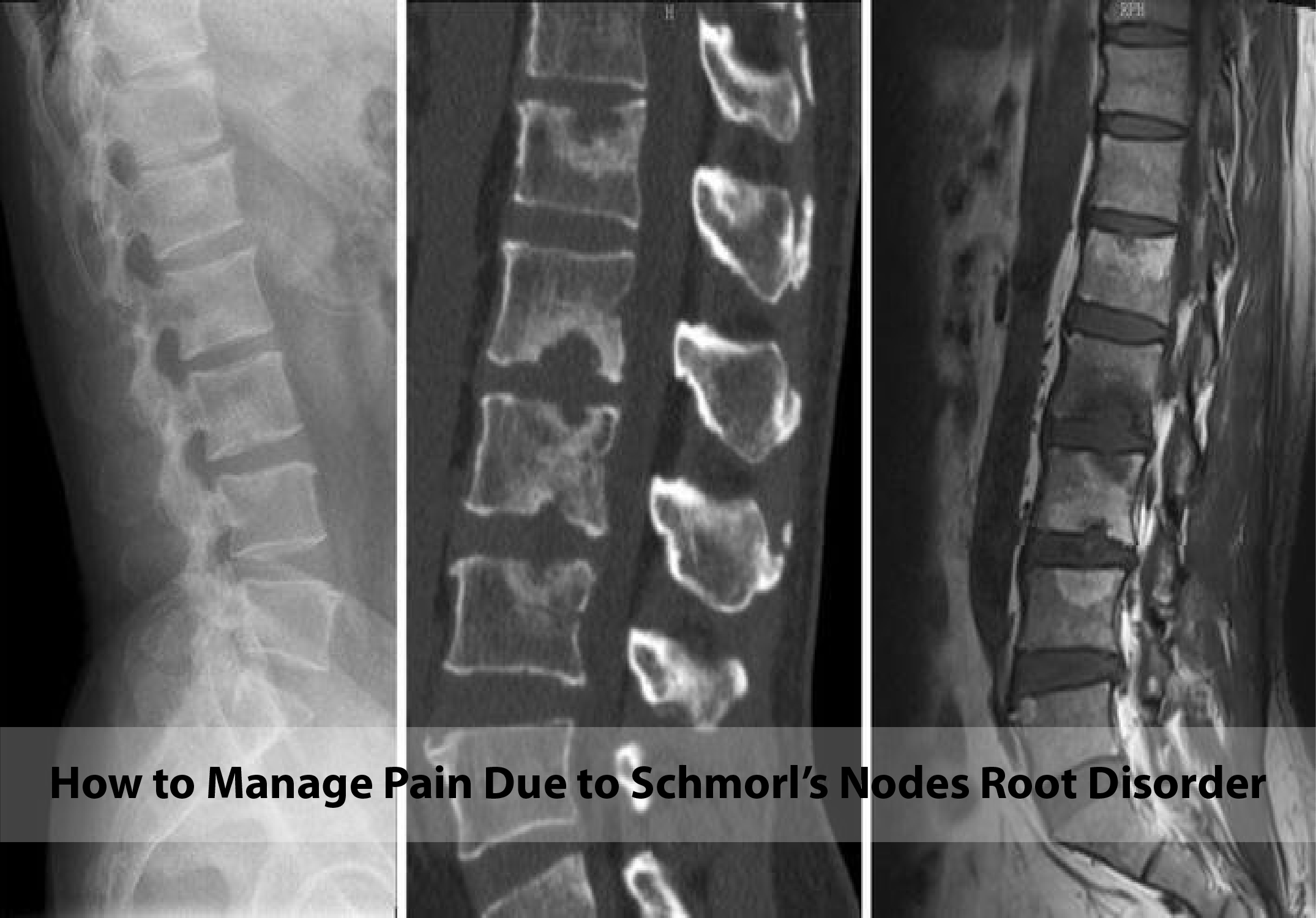 How to Manage Pain Due to Schmorl’s Nodes Root Disorder